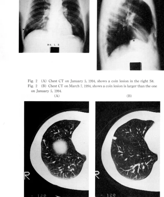 Fig.  2  (A)  Chest  CT  on  January  5,  1994,  shows  a  coin  lesion  in  the  right  S8.