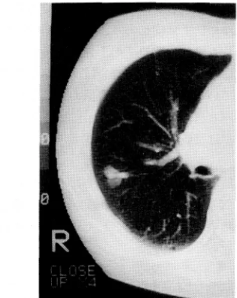 Fig.  6  Microscopic  view  of  the  resected  right upper  lobe.  There  is  a  Dirofilaria  immitis  which induced  embolism  in  the  vessels.