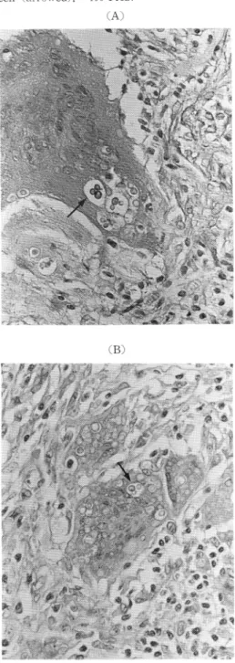 Fig.  3  The  bronchoscopic  biopsy  specimen  of  case
