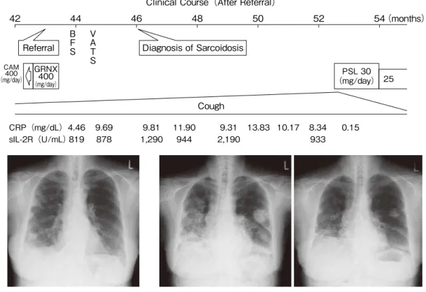 Figure 6.   臨床経過 考察 本症例はサルコイドーシス発症時に63歳で，関節リウ マチの診断からおよそ３年半が経過していた．岡本らの 検討では，関節リウマチ初発患者におけるサルコイドー シスの発症年齢は41–75歳（平均57.4歳）であり，関節リ ウマチの発症からサルコイドーシス発症までの期間は１ –15年（平均7.5年）であった 2） ．本症例の関節リウマチ発 症からサルコイドーシス発症までの期間は平均よりも短 かった．また，本症例では炎症所見が著明で，発熱もみ られたが，わが国で報告されたサル