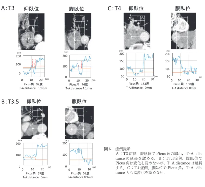 図 症例提示 Ａ：T3症例．腹臥位で Pi cus角の縮小，T‑A  di s  -t anceの延長を認め る．Ｂ：T3.5症 例．腹 臥 位 で Pi cus角は変化を認めないが，T‑A di s t anceは延長 する．Ｃ：T4症例．腹臥位で Pi cus角，T‑A  di s  -t anceともに変化を認めない． 表 術前/導入療法前後における T3の８症例 性 別 年 齢 化学療法 Pi cus角 (仰臥位) Pi cus角 (腹臥位) Pi cus角の差 (腹臥位‑仰臥位) T‑A  di 