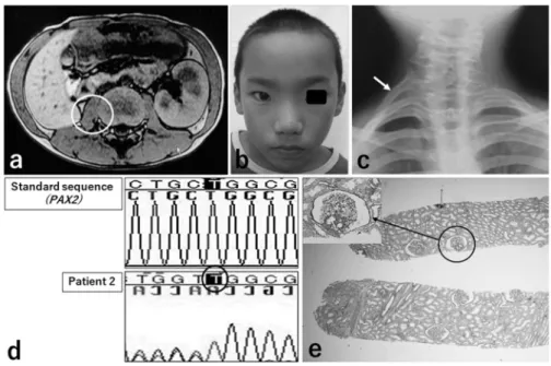Figure  1  Patient  2.  Images,  facial  features,  and  histologic  findings  of  the  kidney  (periodic  acid-Schiff  stain,  original magnification, x40), and gene analysis findings