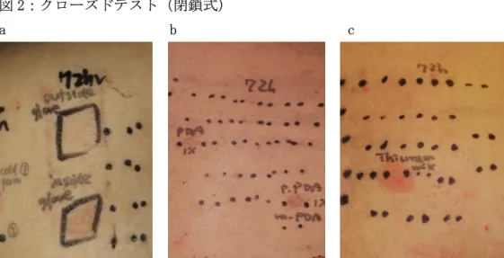図 2：クローズドテスト（閉鎖式）  a                      b                       c  a：使用中ゴム手袋を小片に切って閉鎖貼付  b：毛染めアレルゲンに陽性  c：ゴム加硫促進剤に陽性  アトピー素因と職業性皮膚炎  当施設での職業性接触皮膚炎患者パッチテスト検討成績 22 例（2004~2009）をまとめ てみると男女比はなく（♂：♀＝１１：１１）、平均年齢は 28.9 才でした。その内訳は 理容・美容師８例、自動車整備工３例、メッキ作業員、金属部品製造