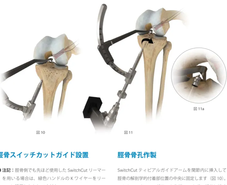 図 10 図 11 図 11a 注記：脛骨側でも先ほど使用した SwitchCut リーマー を用いる場合は、緑色ハンドルの K ワイヤーをリー マーに設置しなおしてください。 SwitchCut ティビアルガイドアームを関節内に挿入して脛骨の解剖学的付着部位置の中央に固定します（図10 ）。SwitchCutリーマーがアーム先端のエルボー部分に達す るまで、脛骨外側皮質骨から関節内に向けて正回転でリー ミングします（図 11, 11a ）。ブレットを 90 度回転してガ イドボディから外します。脛骨スイッ