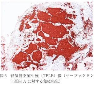 図 5 経気管支肺生検（TBLB）像（Alcian blue-PAS 染色） 肺胞腔内に充満する物質は，顆粒状に PAS 染 色陽性を示している． 図 6 経気管支肺生検（TBLB）像（サーファクタント蛋白 A に対する免疫染色）肺胞腔内に充満する物質は陽性であり，肺サーファクタント成分を含むことを示している．