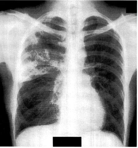 Fig.  1  Chest  X-ray  on  admission,  with  infiltrative  shadow  in  the  right  upper  lung  field.