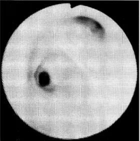 Fig.  3  Complete  obstruction  of  the  orifice  of  right  B2  covered  with  normal  mucosa  seen  on  bronchoscopy.