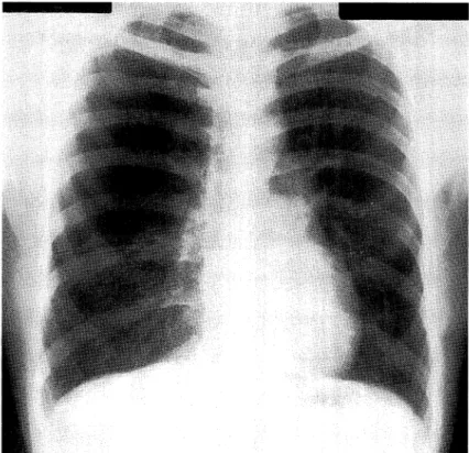 Fig.  6  The  resected  lung  contains  dilated  bronchi  containing  mucoid  material  in  the  hilar  region  of  S2,  and   emph-ysema  associated  with  obstructive  pneumonia