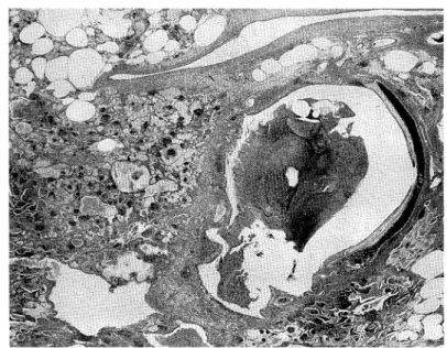 Fig.  7  Photomicrograph  of  a  cystically  distended  bronchus. 