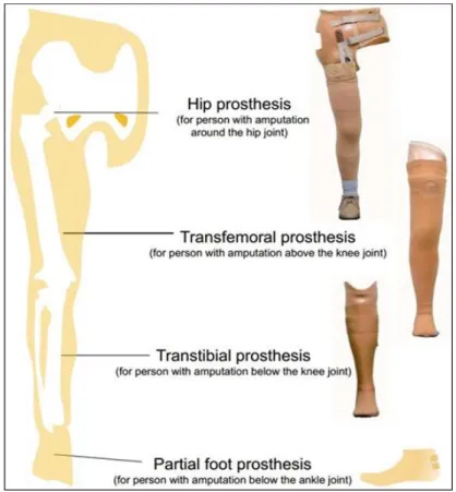 Figure 1.1 Level of Amputation (NRCD - Japan) 
