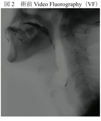 図 2    術前 Video Fluorography （ VF ）