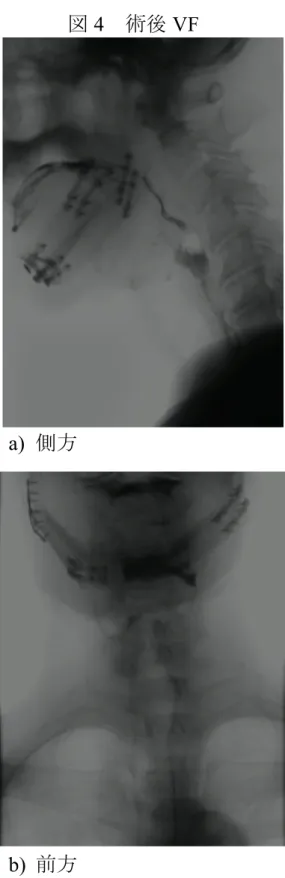 図 4    術後 VF 