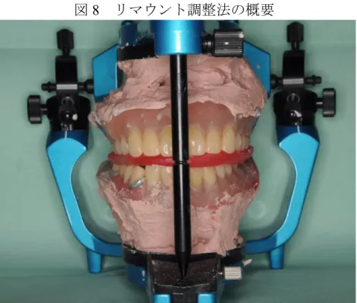 図 8    リマウント調整法の概要