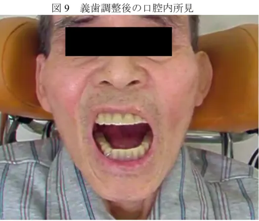 図 9    義歯調整後の口腔内所見