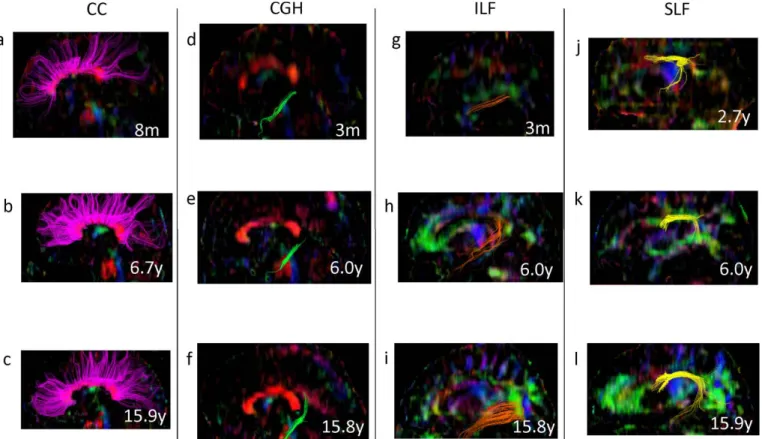 Figure 5. Sample tractography of the white matter tracts on sagittal slice at infants (age &lt; 6 years),  children (6 years &lt; age &lt; 10 years) and adolescents/adults (age &gt; 10 years)