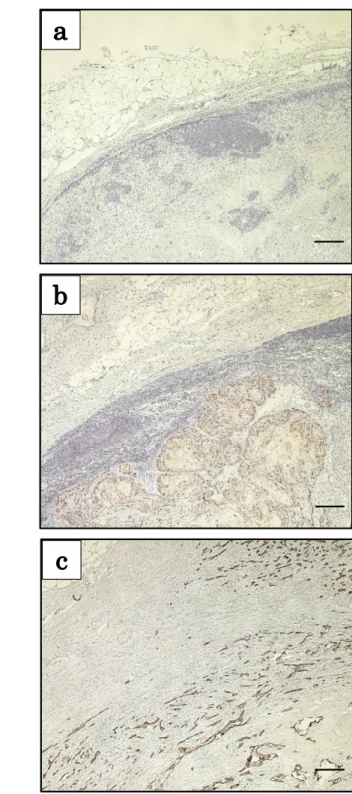 図 2.  OSCC 頸部リンパ節転移巣における CK19 の発現様式  （a）A 群では、転移巣の腫瘍細胞に CK19 の発現は認められない。 （b）B 群では転移 巣の腫瘍細胞に CK19 の発現を認める。 （c）C 群では被膜外に浸潤した腫瘍細胞にも CK19 の発現を認める。scale bars: 200 µm。 A B C abc