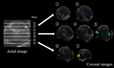 Fig. 3. Methods used to quantify the bone-resorptive volume of the entire femoral head.