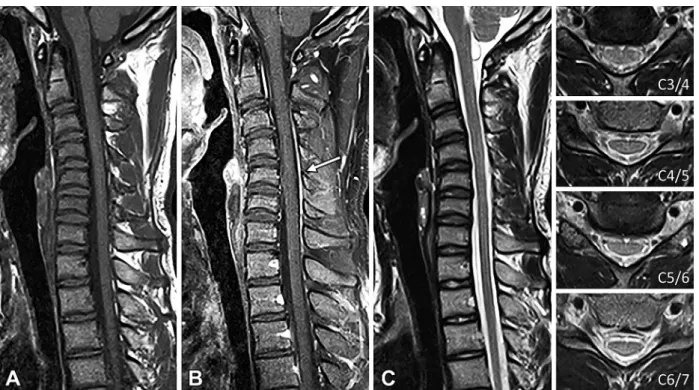 Fig. 3 Cervical MR images in the neutral position showing mild kyphosis of the cervical spine.