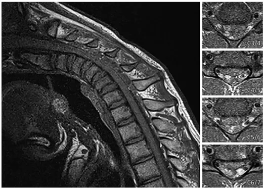 Fig. 4 MR images in the neck flexion position.