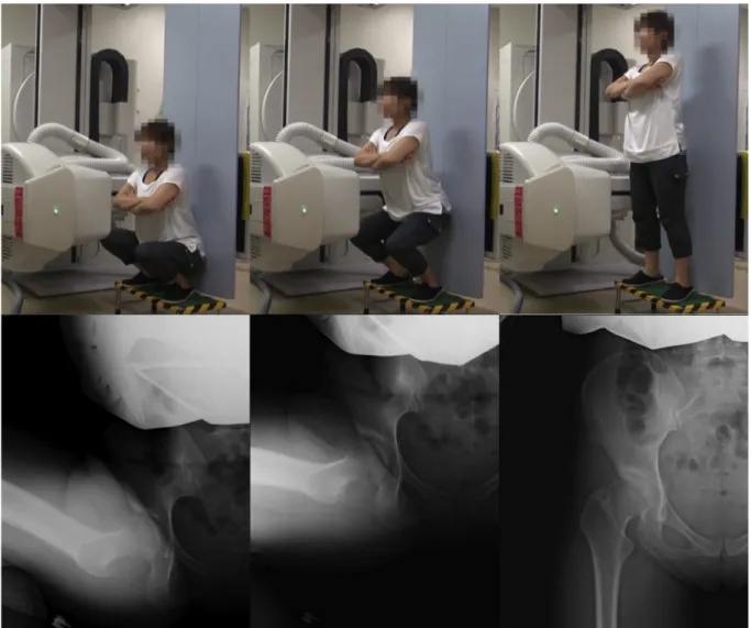 Fig. 1. All the subjects were asked to squat dynamically with the feet at shoulder width and heels ﬂat (upper stand) under radiographic surveillance (lower stand)