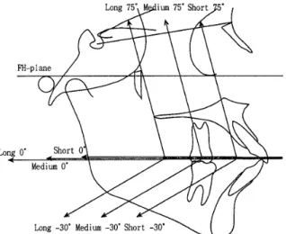 Fig 。 1 　 Cephalometric 　 tracillg 　 showing 　 the dire¢ tions 　 of 　 tractlon 　 for 乱 skull 　 with 　 high pa ！ atal 　 plane 　 ang ！e ．
