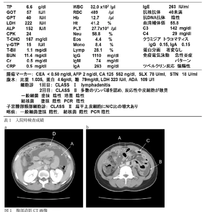 表 1　入院時検査成績 図 1　腹部造影 CT 画像 　腹水の貯留（A），腹膜（B）および腸管（C）の造影効果の増強，5mm 大の粟粒結節の集積（D）を認めた． 図 2　骨盤部 MRI 画像 　卵巣（A）の腫大はなく，大網の網状肥厚（B）を認めた．aabb
