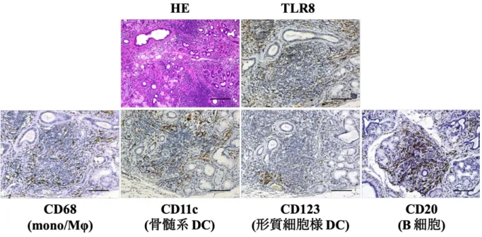図 12.  SS の⼝唇腺における TLR8 の発現と局在 Scale bars: 100 µm  2-4.  ⼝唇腺における TLR8 の発現細胞の検索          これらの結果を考慮して、実際に SS 患者の⼝唇腺における主な TLR8 発現細胞の検索のために、蛍光⼆重免疫染⾊を⾏った。代表的な症例を図 13 に⽰すが、TLR8 は主に mono/MΦ（CD 68 陽性細胞）と局在が⼀致し た。さらに、17 例の SS 患者に対して蛍光⼆重免疫染⾊を⾏い、各細胞の TLR8 陽性率を半定量的に解