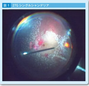 図 1 27G シングルシャンデリア 図 2 硝子体吸引流量の計算式と改善策