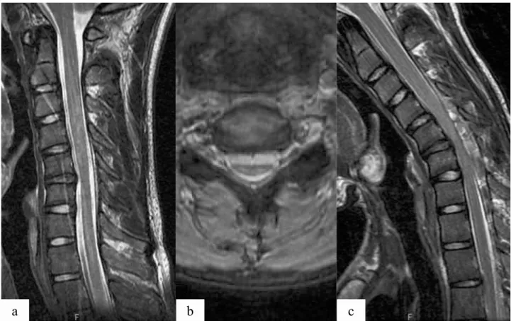 Figure 1. 	 A 17-year-old male adolescent presents with slowly progressive weakness and atrophy of the left upper extremity