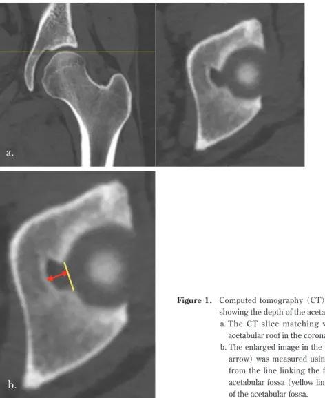 Figure 1. 	 Computed tomography （CT） scans of the left hip 