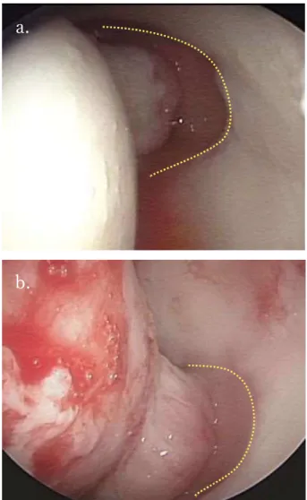 Figure 3. 	 An example of a patient with fibrous cartilage formation 