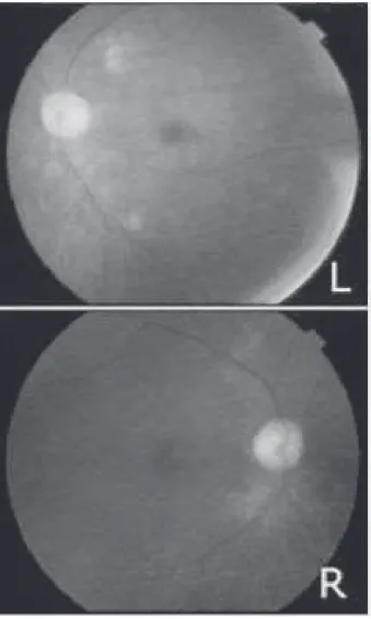 図 2  眼底検査：左眼底に cherry	red	spot を認めた． 図 3  病理組織学的所見（HE 染色，弱拡大）：側頭動脈内膜肥 厚を認める．リンパ球やマクロファージ，巨細胞の浸潤は 見られない． — 43 —CRP値は 0.03-1.29mg/L で推移している．発熱は治療開始後すみやかに 37 度以下に解熱し，食欲低下・意欲低下の症状も改善している．左眼視力は指数弁程度まで回復したものの完全な回復には至っていない．また胸腺カ ルチノイド術後1年経過しているが無再発生存中である．考　　　　　察今