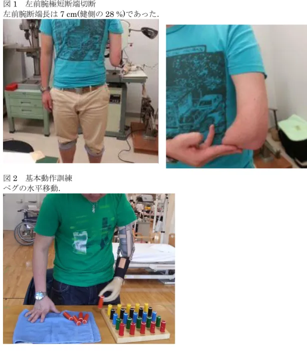 図 1  左前腕極短断端切断 