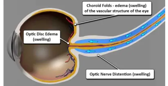 図 4.1.2-5  Vision Changes in Space (2014 年 2 月  NASA の動画より)  Swelling(腫れ)、edema(浮腫)、distention(膨張)、Choroid fold(脈絡膜のしわ) 