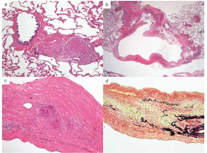 Figure 4.　経過胸部HRCT． X＋1年2月：両肺粒状影が悪化した．Figure 3.　肺病理組織所見（右S2）． a ．気管支肺動脈束に沿ってみられた類上皮細胞肉芽腫．血管構造は保たれていた． （HE染色，×10） b ．囊胞壁内に炎症細胞浸潤を認めた．（HE染色，×1） c ．3bの拡大像．囊胞壁内の多核巨細胞肉芽腫．（HE染色，×10） d ．線維性囊胞壁の弾性板を一部破壊する肉芽腫．（EVG染色，×10）abcd