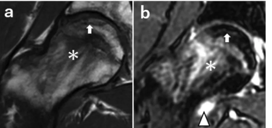 Fig. 3. Coronal T1-weighted MR image (a) and fat-suppressed T2-weighted image (b). BME manifested as a di ﬀ use,  low-signal intensity area on T1-weighted images with a  corre-sponding high-signal intensity on a fat-suppressed  T2-weighted image around the