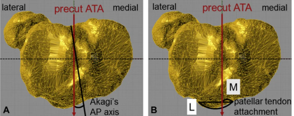 Fig. 4. Evaluation of the precut ATA. (A) the angle between the precut ATA and Akagi's AP axis, (B) medial percentage width was deﬁned as M/L  100 at the patellar tendon attachment level (medial edge: 0%, lateral edge: 100%)