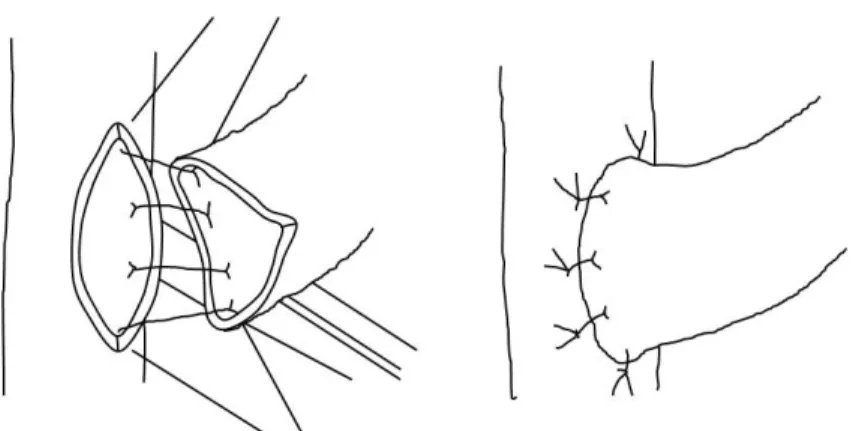 Fig. 2.   Left : Placement of interrupted full thickness sutures of each ureter.  
