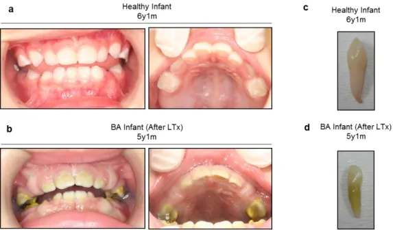図 3-3-2 ． 4 歳の胆道閉鎖症患児（ #2 ）の口腔内写真。 