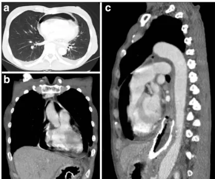 Fig. 3 Contrast-enhanced CT showing fluid and air in the pericardium. (a) Axial view. (b) Coronal view