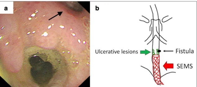 Fig. 6 (a)  Fluoroscopy  showing  SEMS  being  implanted  in  the  proximal  site  of previously  implanted  SEMS