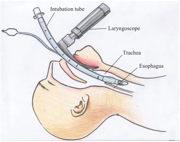 Figure 1.3 Endotracheal Intubation (ETI). 