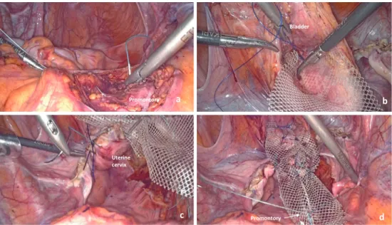 Figure 6. Laparoscopic sacral colpopexy (LSC).
