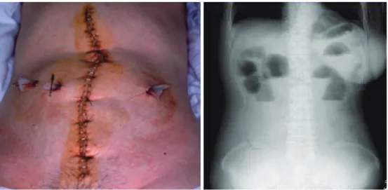 Figure 9. Para-aortic lymphadenectomy by laparotomy.