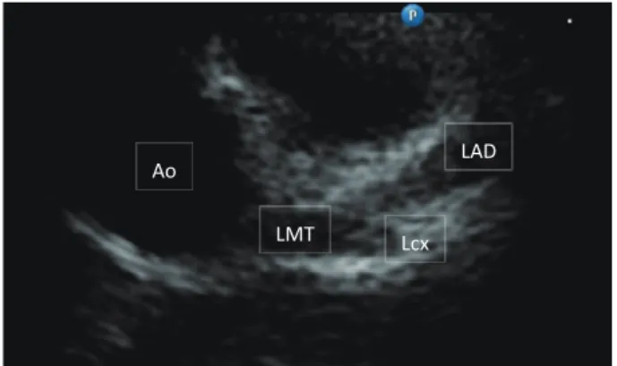 Figure 3 Echocardiography  of  left  coronary  artery  at 16th illness day.