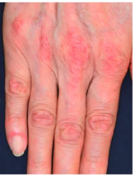 Figure 5 Facial erythema (dermatomyositis). Figure 6 Nail fold bleeding (systemic sclerosis)