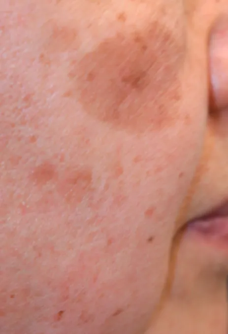 Figure 10 Senile pigment freckle. て受診されるようになってきたことが注目される． また，頭部全体の疎毛を主訴に来院し，治療を希 望される女性も増えている． 1）老人性色素斑 多くは中年以降の顔面，前腕，手背に生じる黒褐 色調もしくは褐色調の斑状病変である（Figure 10）． 時に悪性黒子を鑑別する必要がある．急激な拡大が みられる場合，左右不対称の色調の濃い病変や濃淡 のある色調を有する病変の場合には皮膚科専門医の 診察をお勧めしたい．治療としては自費診療とはな るが，