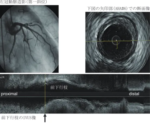 Figure 5 Coronary  angiogram  and  intravascular  ultrasound  (IVUS)  images  obtained  2  years  after  heart  transplantation  in  a  46-year-old  recipient.  The  coronary  angiogram  showed slight irregularity of the vessel wall, but diffuse intimal hy