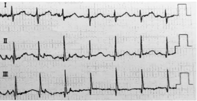 Figure 3 Electrocardiographic findings Day 9.