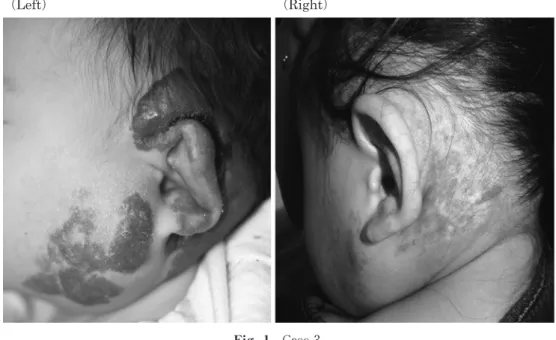 Fig. 1 Case 3   Left: Before the therapy (2 months old). Right: Just after finishing the therapy (23 months old)
